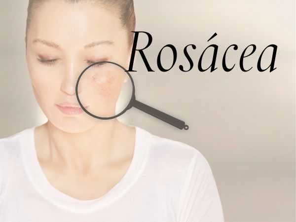 Transforma tu piel con nuestra rutina skincare para rosacea