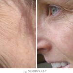 Transforma tu piel con Osmosis Skincare: antes y después