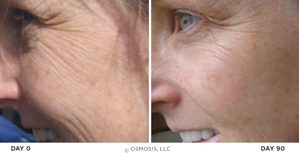 Transforma tu piel con Osmosis Skincare: antes y después