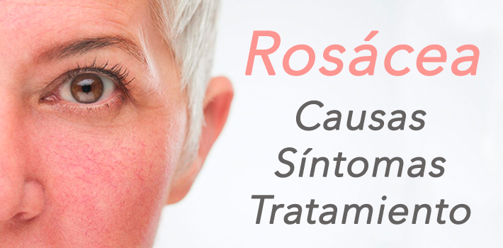 Tratamiento efectivo para la rosácea con nuestra rutina de skincare