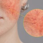 Tratamiento natural para rosácea en la piel