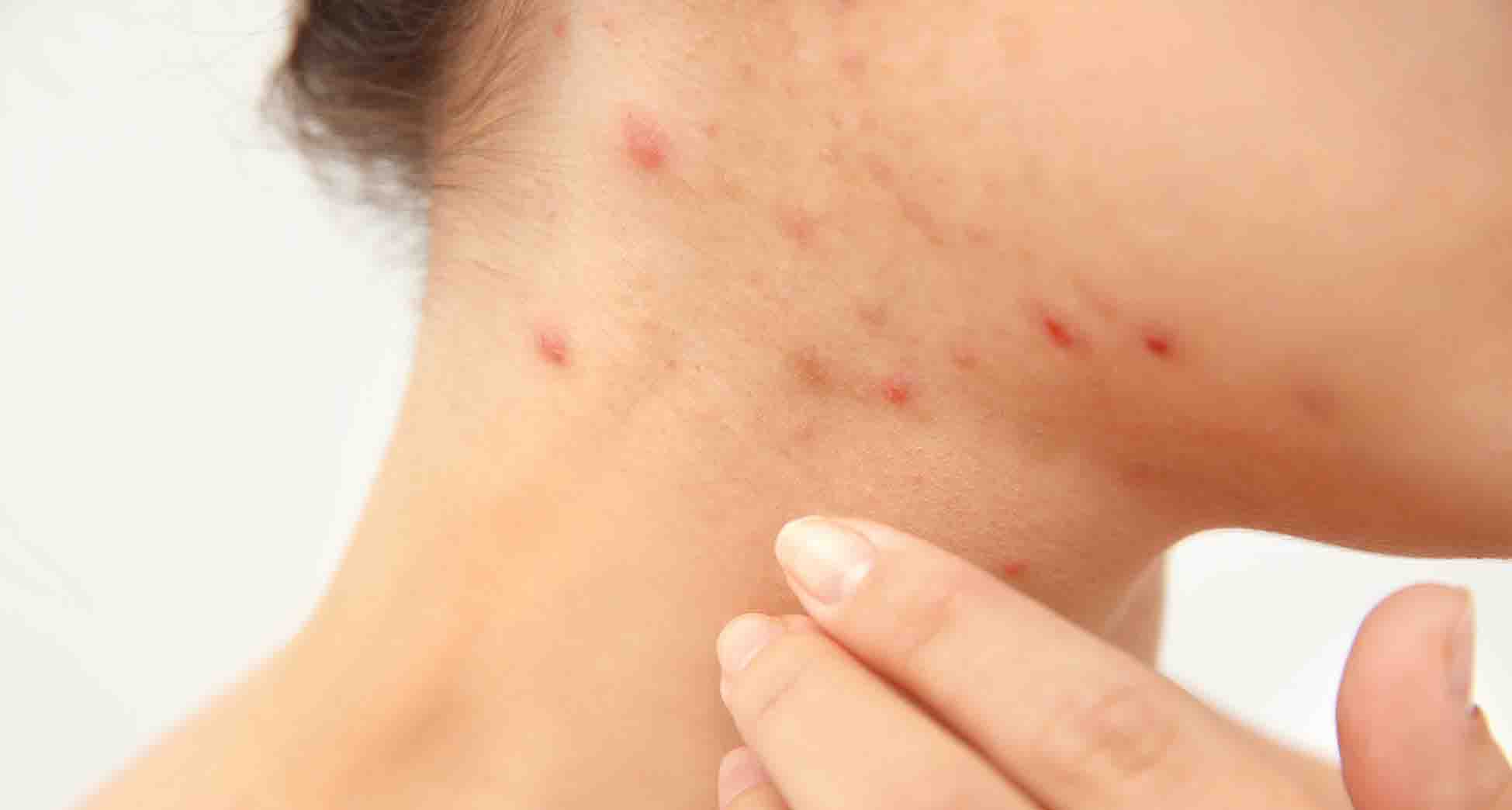 Tratamiento seguro para el acné durante el embarazo