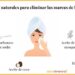 Tratamientos caseros para el acné: ¡adiós a las imperfecciones!