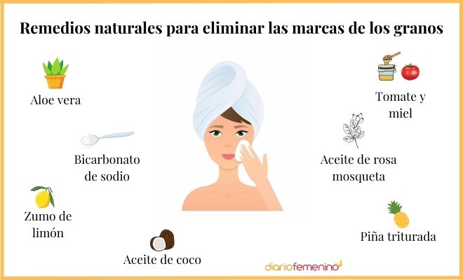 Tratamientos caseros para el acné: ¡adiós a las imperfecciones!